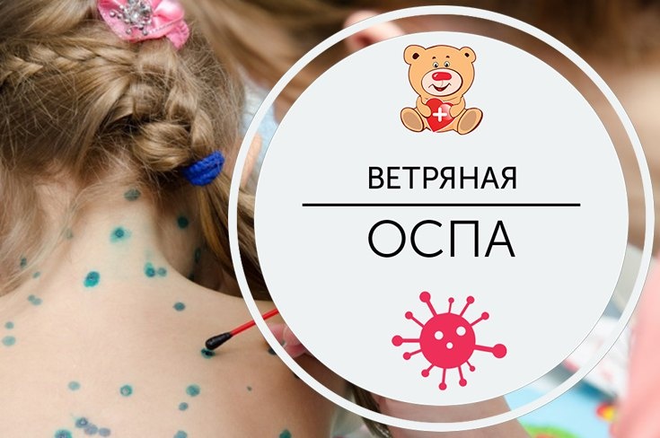 Ветряная оспа.